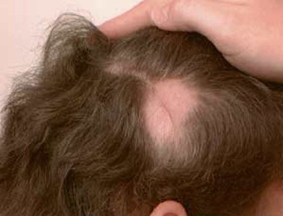 Premature Baldness