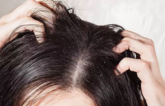 Dandruff